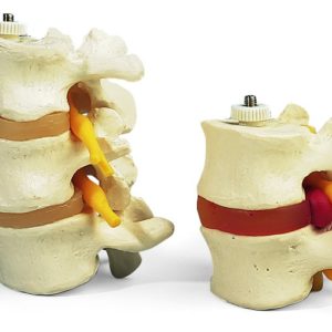 1000152 2 vertèbres lombaires avec prolapsus du disque intervertébral, montage élastique 10001523B Scientific